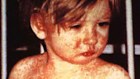 The highly infectious disease is especially dangerous for young children who haven't had the MMR vaccination.