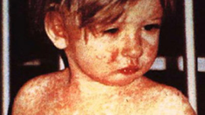 Measles will be back after 22 million babies miss their shots: WHO