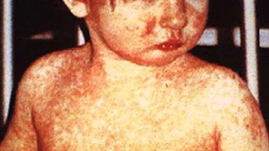 It's back. Measles, a disease long thought conquered in Australia, is re-emerging. 