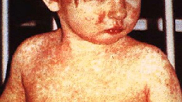 It's back. Measles, a disease long thought conquered in Australia, is re-emerging. 
