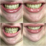 Catherine Bouris' teeth before, during and after using charcoal toothpaste. Top from L-R: Before April 8, April 23. Bottom from L-R: May 12, May 31. 