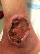 Flesh-eating Buruli ulcer cases soar as disease spreads to Melbourne