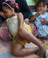 Saskia, aged six, at home in Sekotong village. She was born with deformed hands and feet.  