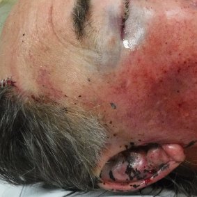 The 71-year-old required stitches to a head injury.