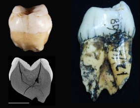 The incisor and molar discovered by Eugene Dubois in 1890.