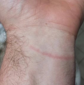The mark the protester claims left on his wrist after an arrest over an oil pipeline demonstration.