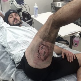 Gareth Clear, 36, of Bondi says his iPhone exploded, causing him serious burns, after he fell off his bike on the weekend. 