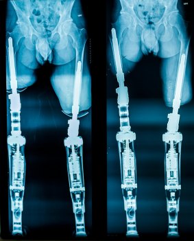 Behind the scenes: X-rays demonstrating osseointegration.