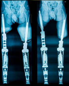 An X-ray demonstrating osseointegration.