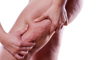Cellulite The Truth About The White Woman S Curse
