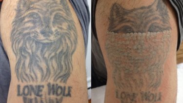 Before and after shots of a tattoo removal at Melbourne Tattoo Removal. 