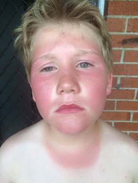 Damien McCaull got sunburnt on Australia Day. 
