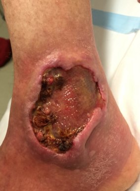 A flesh-eating ulcer on Jan Smith's ankle left her unable to walk.