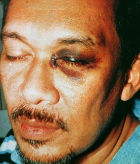 Anwar Ibrahim was beaten by a former police chief while he was in custody in 1998. His treatment led to a Royal Commission. 