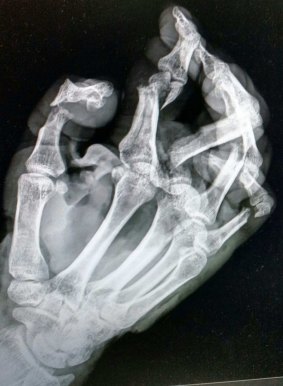 An X-ray of Dean Reid's mangled hand.