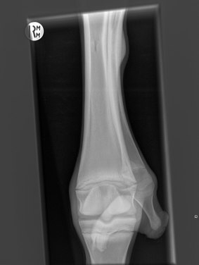 Proof: An x-ray showing Spare Parts' additional limb prior to the operation.