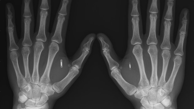 Smart implants: This X-ray depicts the hands of Amal Graafstra, who has had two radio frequency identifier implants in his hands which he uses to unlock his car, computer and door to his home.