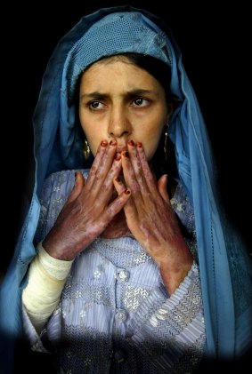 Paula Bronstein's 2004 image of Masooma, 18, who has severe burns on 70 per cent of her body from self-immolation.
