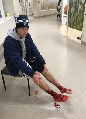 Bloody mess: Sam Kanizay in Emergency at Sandringham Hospital on Saturday night, his lower legs bloody after bathing in the bay at Brighton. 