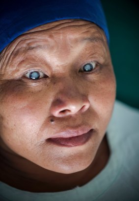 Mina Tamang had cataracts in both eyes. 