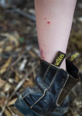 The bite marks of an brown snake on Tayla Ballard. 