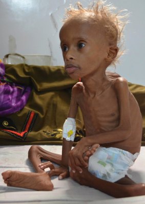 Salem, 5, who suffers from malnutrition, sits on a bed at a hospital in the port city of Hodeidah, southwest of Sanaa, Yemen, in September. 