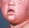 Health warning: Measles carried to Melbourne by child on flight from Jakarta