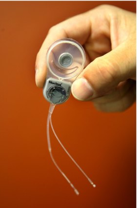 A Cochlear Implant 