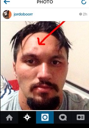 Jordan Rapana's Instagram photo of his head injury, a fractured skull, in August.