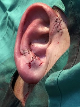 Twelve stitches were required to repair the ripped ear.