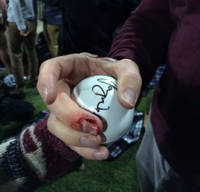 Tom Zouch's finger after catching a 'six' during the BBL half time show.