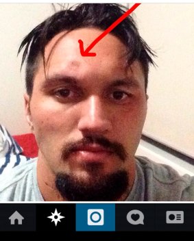 Jordan Rapana's Instagram photo of his injury.