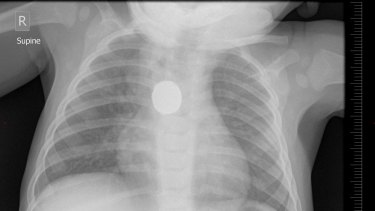 The x-ray showing a lithium button battery in Leo's oesophagus.