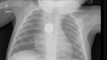An x-ray showing a button battery lodged in the oesophagus of a 9-month-old boy.