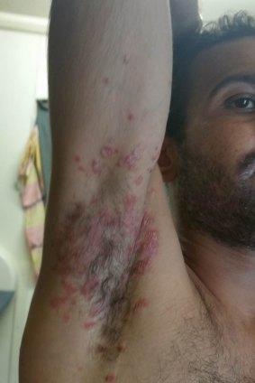 Amin has a severe case of psoriasis which he believes is not being treated properly. 