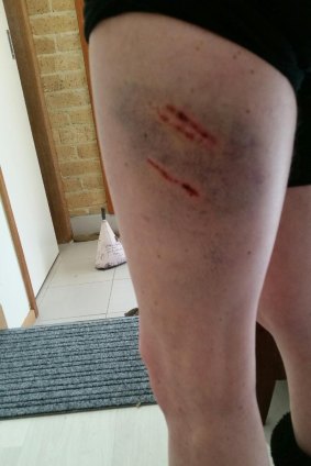 Photos of Livia Auer's injuries after she was attacked by a dog in Stirling last month.