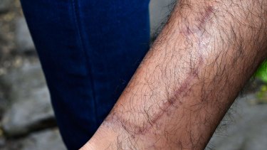 Scars on Grant Uranie's leg.