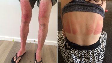 The Bueti family (father on left, daughter on right) from Adelaide used the Cancer Council aerosol spray sunscreen but still got burnt at the beach.