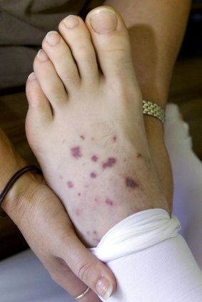 Menigococcal rash.