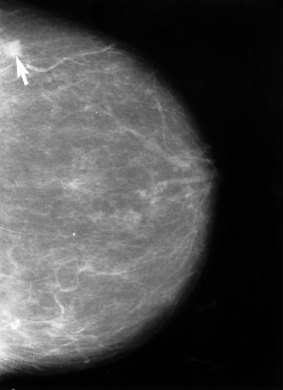 Mammogram: Dense breast tissue can make tumours difficult to detect.