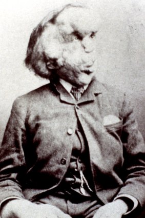 Joseph Merrick, Victorian England's famous "Elephant Man".