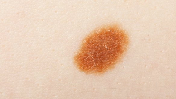 Common lumps and bumps on and under the skin: what are they?