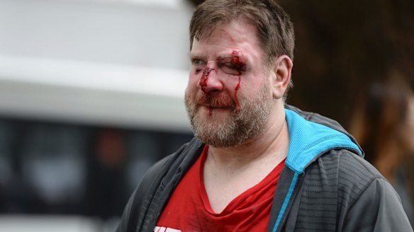 A Trump supporter is injured after sides clash at a rally for President Donald Trump at Martin Luther King Jr. Civic Center Park in Berkeley, California on March 4.
