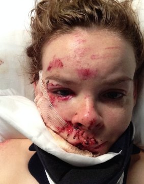 Michelle Weir's facial injuries as seen the day after her April 2015 cycling accident.