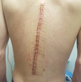 Canberra jockey John Kissick's scar following surgery on his back.