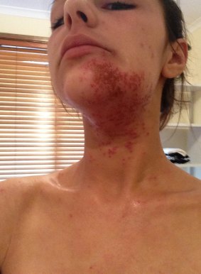 Talia Liolios has a condition called pityrosporum folliculitis, where she is allergic to overgrowth of the natural yeast in her skin.