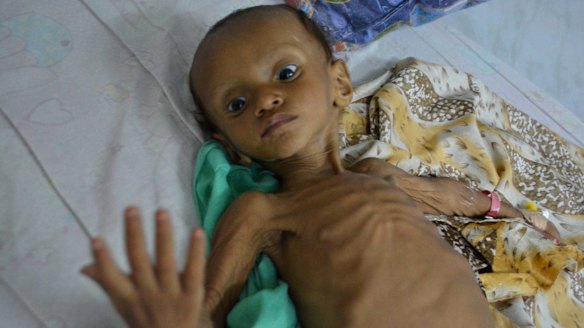 A boy who suffers from malnutrition lies on a bed at a hospital in Hodeidah, Yemen. Even before the war, Hodeidah was one of the poorest cities in Yemen, the Arab world's most impoverished nation. 