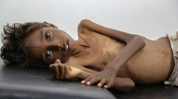Five-year-old Mohannad Ali lies on a hospital bed in Abs, Yemen, in December. His two-year-old cousin died of hunger.