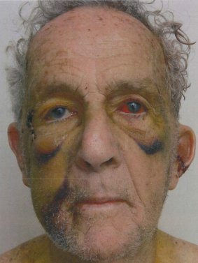Photo of war veteran Ian Gore, 82, taken one month after he was bashed. Police say his injuries were some of the worst they've seen. 