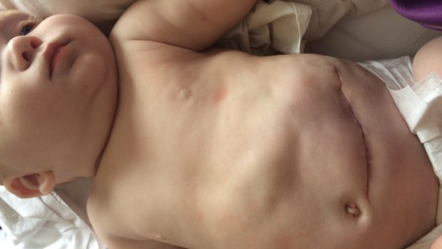 Baby Mason Window faced multiple surgeries.